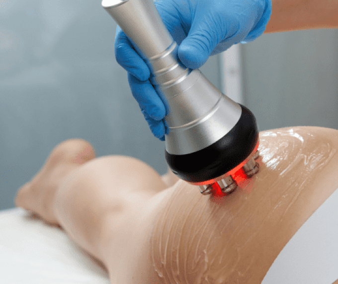 Lipocavitation + Radiofréquence